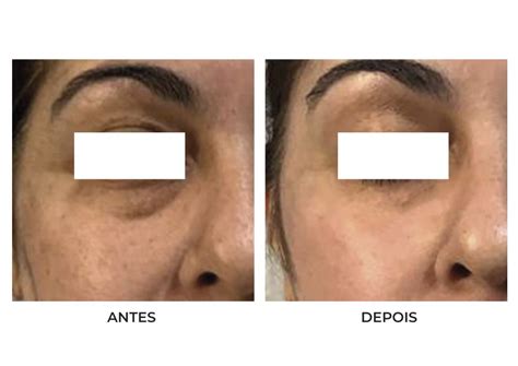 bolsas nos olhos antes e depois